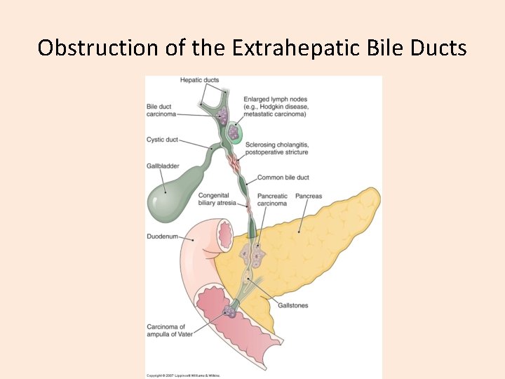 Obstruction of the Extrahepatic Bile Ducts 