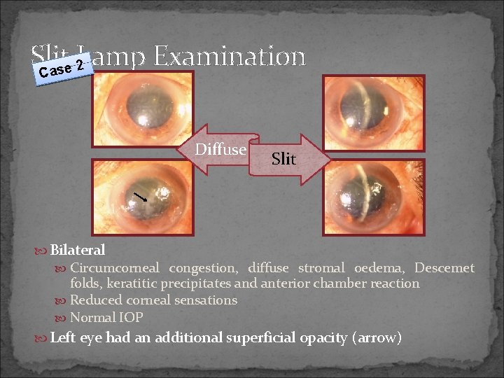 Slit Lamp Examination 2 e s Ca Diffuse Slit Bilateral Circumcorneal congestion, diffuse stromal