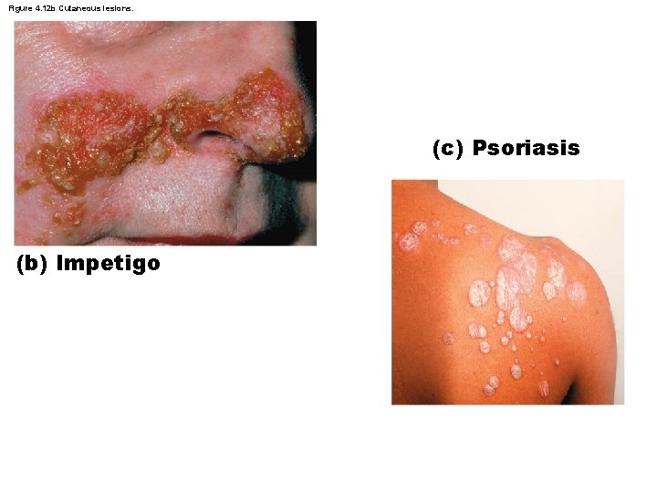 Figure 4. 12 b Cutaneous lesions. (c) Psoriasis (b) Impetigo 
