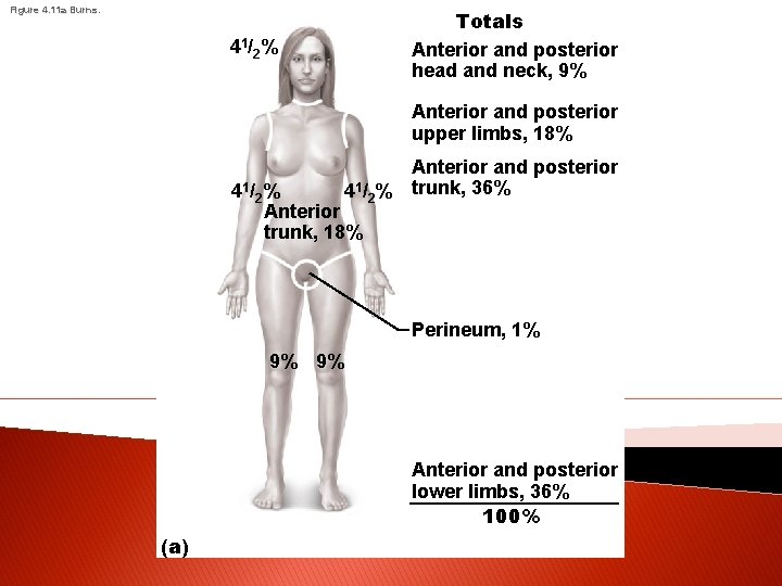 Figure 4. 11 a Burns. Totals Anterior and posterior head and neck, 9% 41