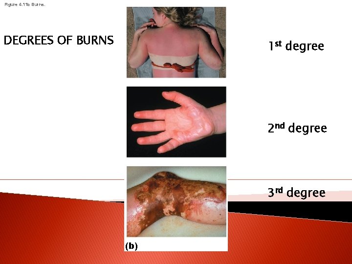 Figure 4. 11 b Burns. DEGREES OF BURNS 1 st degree 2 nd degree