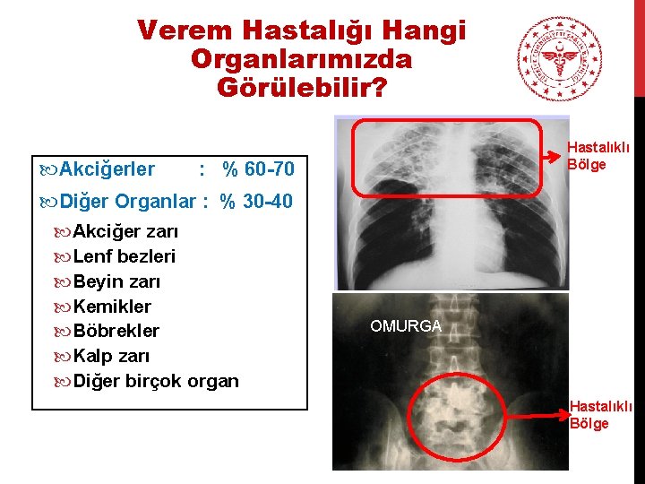 Verem Hastalığı Hangi Organlarımızda Görülebilir? Akciğerler Hastalıklı Bölge : % 60 -70 Diğer Organlar