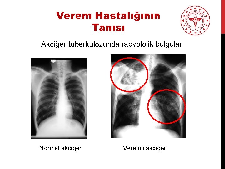 Verem Hastalığının Tanısı Akciğer tüberkülozunda radyolojik bulgular Normal akciğer Veremli akciğer 