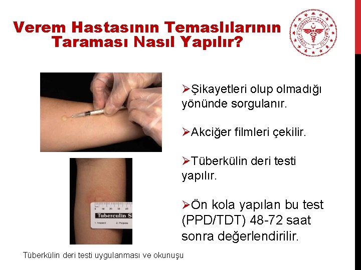 Verem Hastasının Temaslılarının Taraması Nasıl Yapılır? ØŞikayetleri olup olmadığı yönünde sorgulanır. ØAkciğer filmleri çekilir.