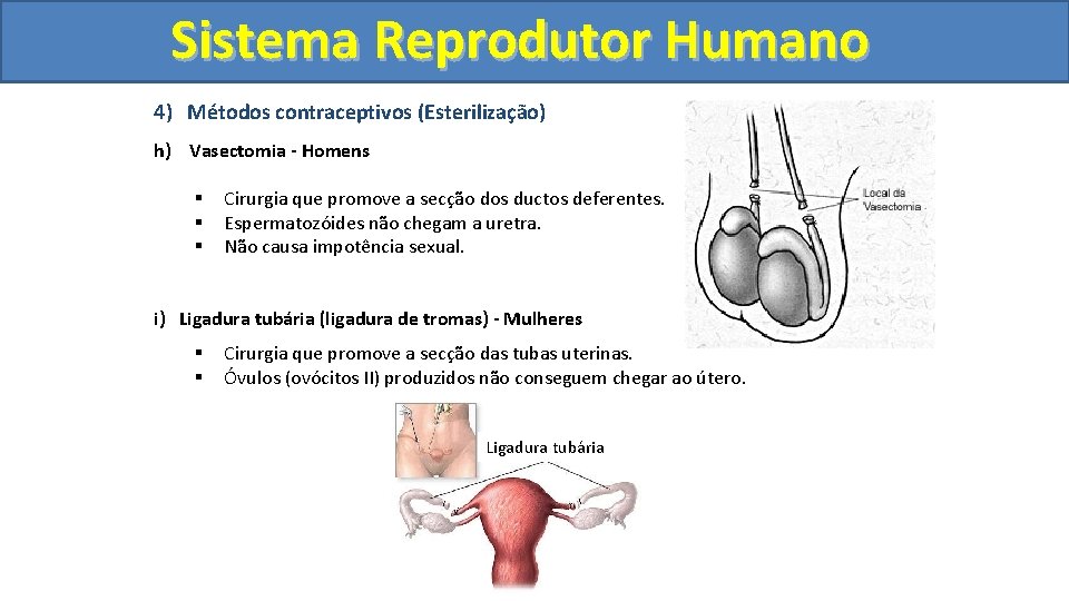 Sistema. Reprodutor. Humano 4) Métodos contraceptivos (Esterilização) h) Vasectomia - Homens § § §