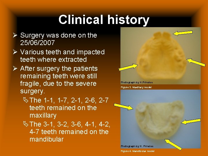 Clinical history Ø Surgery was done on the 25/06/2007 Ø Various teeth and impacted