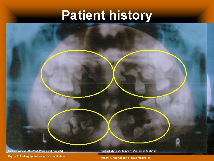 Patient history Ø Ø Ø 18 year-old female Has CCD syndrome Is asthmatic Extreme