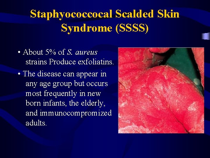 Staphyococcocal Scalded Skin Syndrome (SSSS) • About 5% of S. aureus strains Produce exfoliatins.