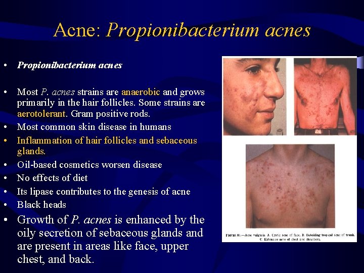 Acne: Propionibacterium acnes • Most P. acnes strains are anaerobic and grows primarily in