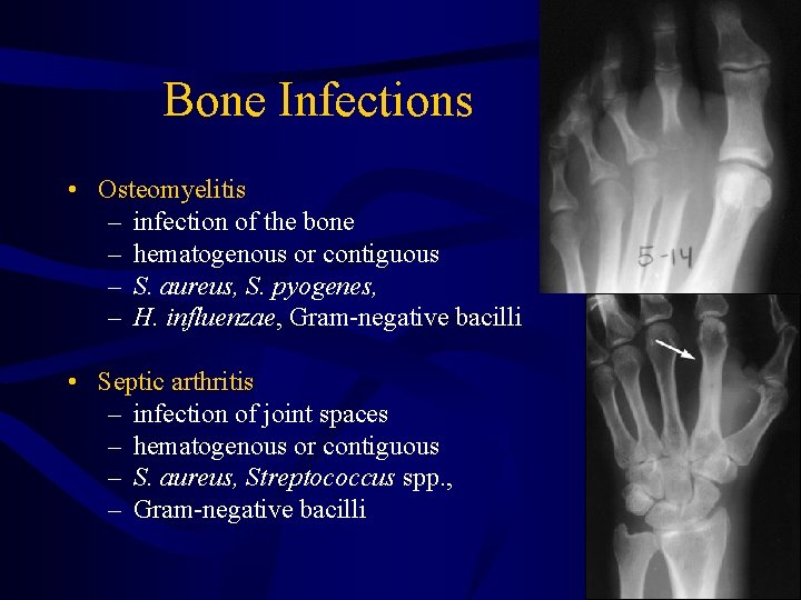 Bone Infections • Osteomyelitis – infection of the bone – hematogenous or contiguous –