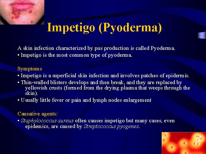 Impetigo (Pyoderma) A skin infection characterized by pus production is called Pyoderma. • Impetigo