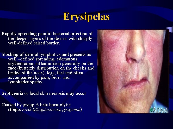 Erysipelas Rapidly spreading painful bacterial infection of the deeper layers of the dermis with
