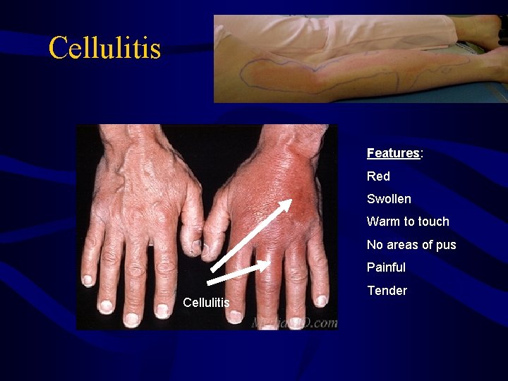 Cellulitis Features: Red Swollen Warm to touch No areas of pus Painful Cellulitis Tender