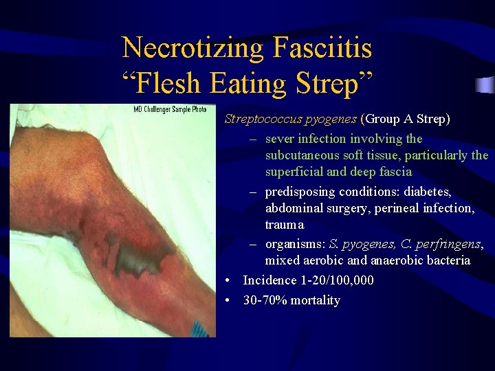 Necrotizing Fasciitis “Flesh Eating Strep” Streptococcus pyogenes (Group A Strep) – sever infection involving