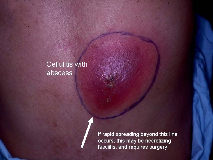 Cellulitis with abscess If rapid spreading beyond this line occurs, this may be necrotizing
