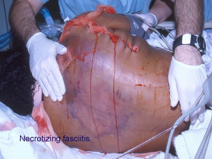 Necrotizing fasciitis 