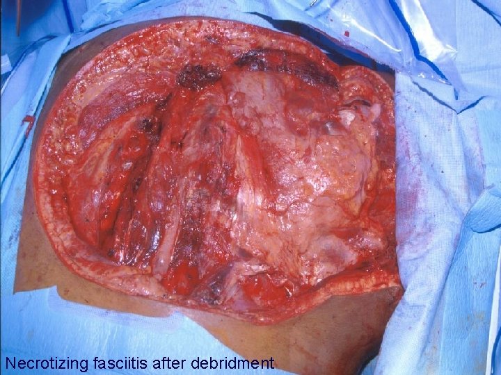 Necrotizing fasciitis after debridment 