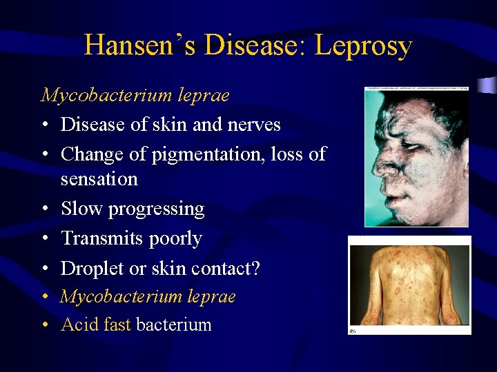 Hansen’s Disease: Leprosy Mycobacterium leprae • Disease of skin and nerves • Change of