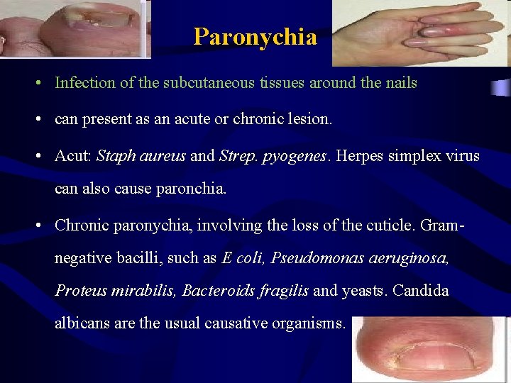 Paronychia • Infection of the subcutaneous tissues around the nails • can present as