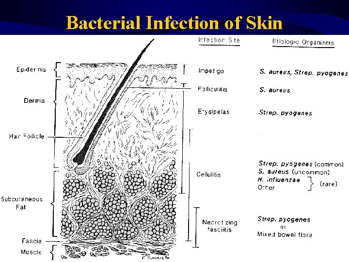 Bacterial Infection of Skin 
