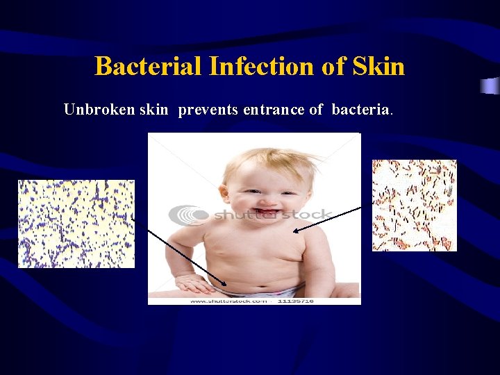 Bacterial Infection of Skin Unbroken skin prevents entrance of bacteria. 