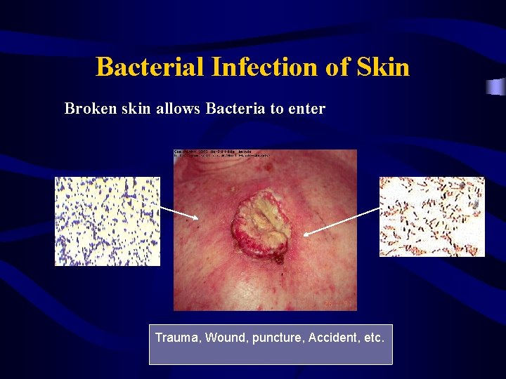 Bacterial Infection of Skin Broken skin allows Bacteria to enter Trauma, Wound, puncture, Accident,