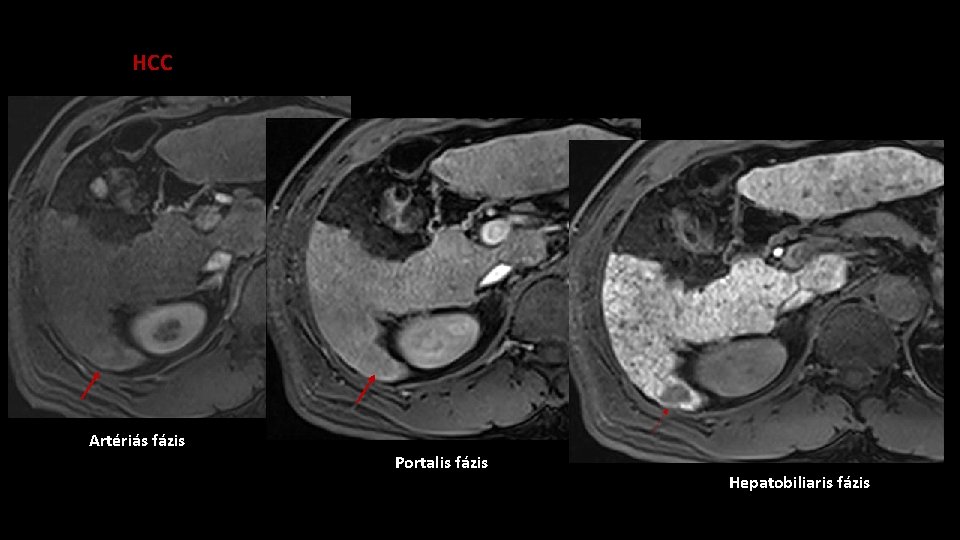 HCC Artériás fázis Portalis fázis Hepatobiliaris fázis 