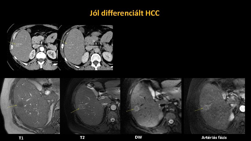 Jól differenciált HCC T 1 T 2 DW Artériás fázis 