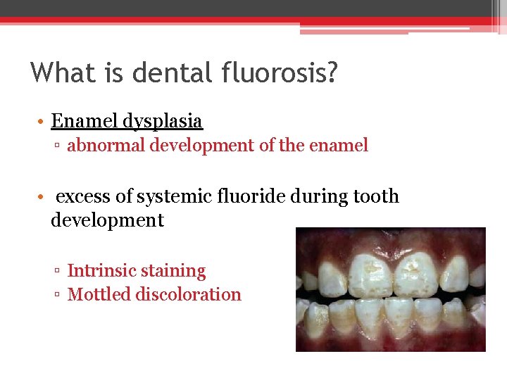 What is dental fluorosis? • Enamel dysplasia ▫ abnormal development of the enamel •