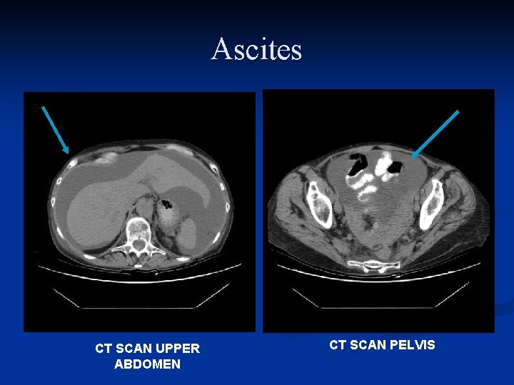 Ascites CT SCAN UPPER ABDOMEN CT SCAN PELVIS 