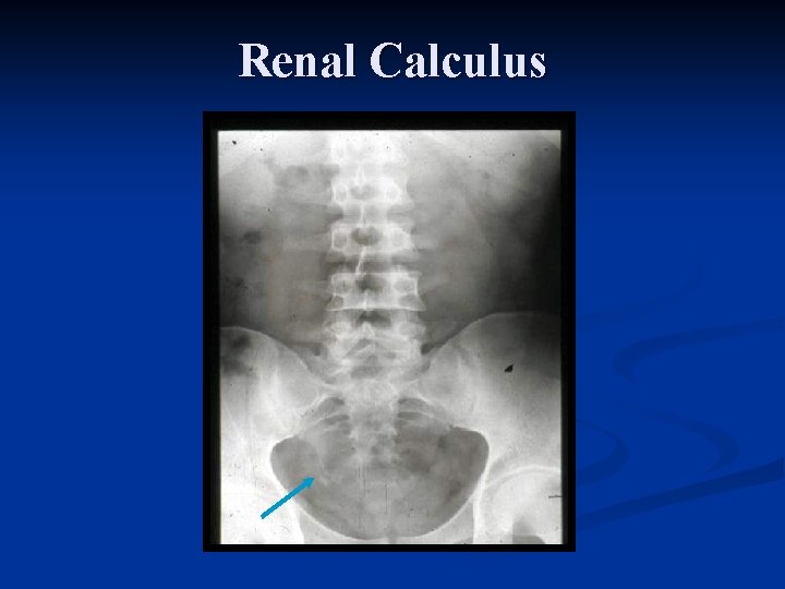 Renal Calculus 
