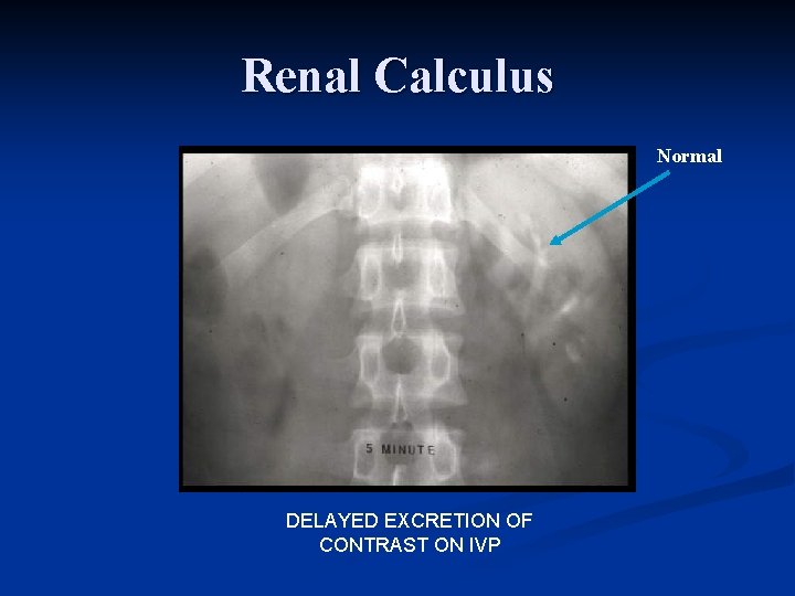 Renal Calculus Normal DELAYED EXCRETION OF CONTRAST ON IVP 