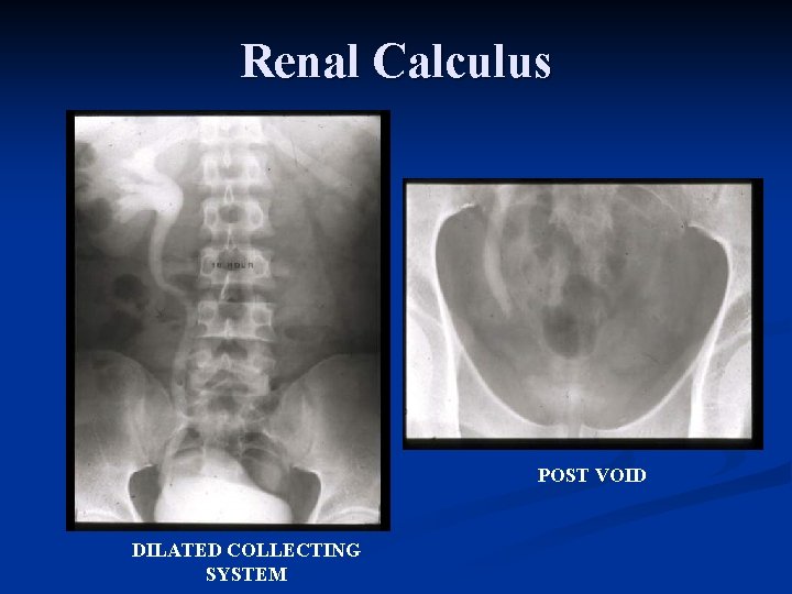 Renal Calculus POST VOID DILATED COLLECTING SYSTEM 