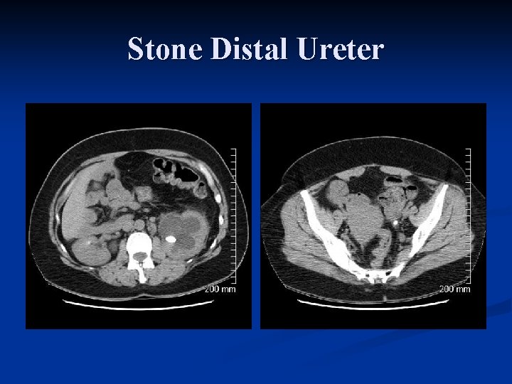 Stone Distal Ureter 