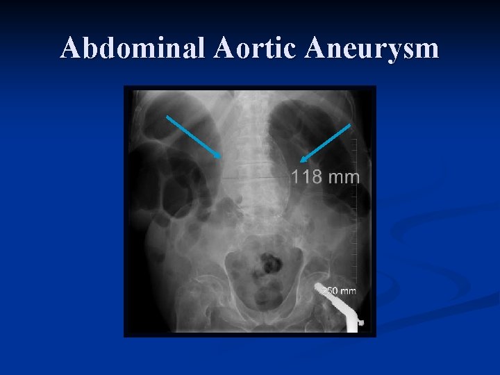 Abdominal Aortic Aneurysm 