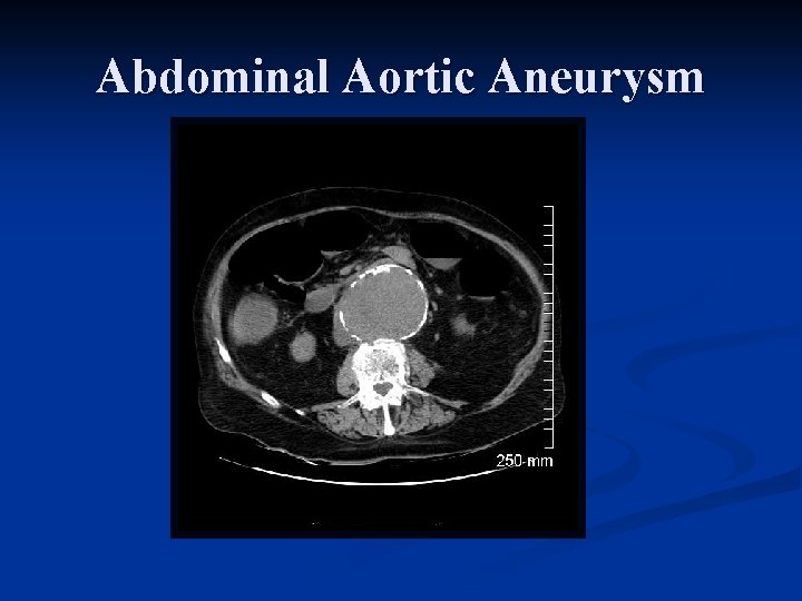 Abdominal Aortic Aneurysm 