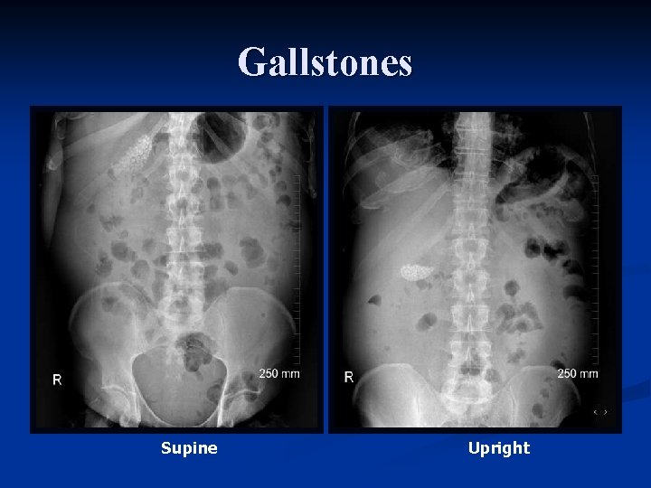 Gallstones Supine Upright 