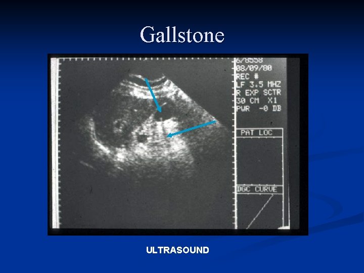 Gallstone ULTRASOUND 