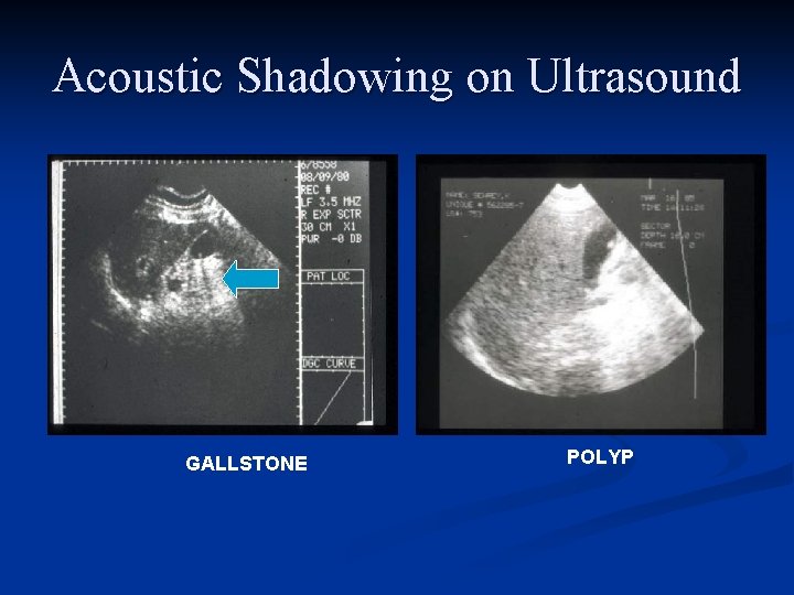 Acoustic Shadowing on Ultrasound GALLSTONE POLYP 