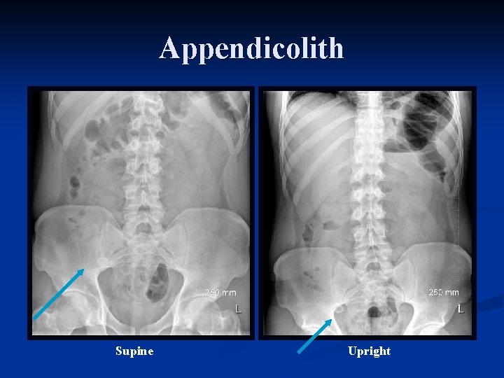 Appendicolith Supine Upright 