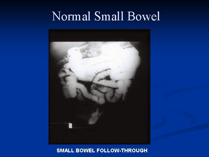 Normal Small Bowel SMALL BOWEL FOLLOW-THROUGH 