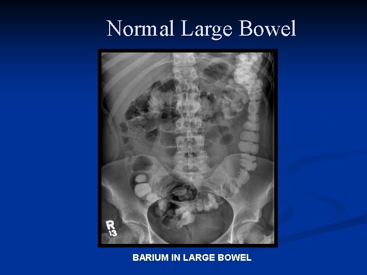 Normal Large Bowel BARIUM IN LARGE BOWEL 