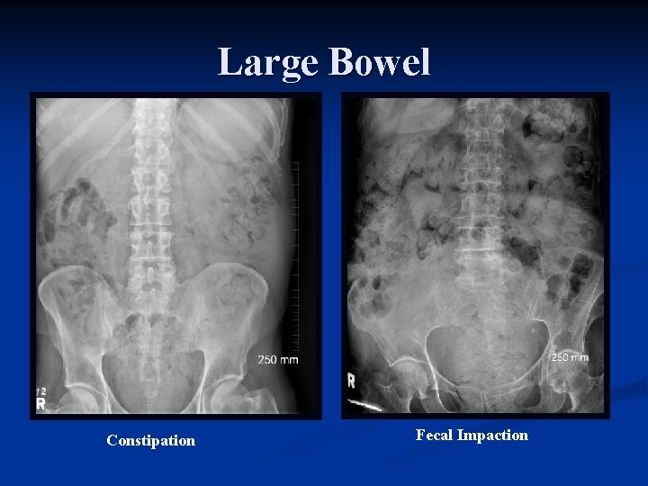 Large Bowel Constipation Fecal Impaction 