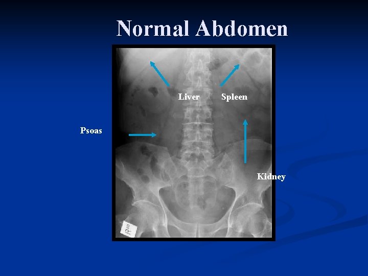 Normal Abdomen Liver Spleen Psoas Kidney 