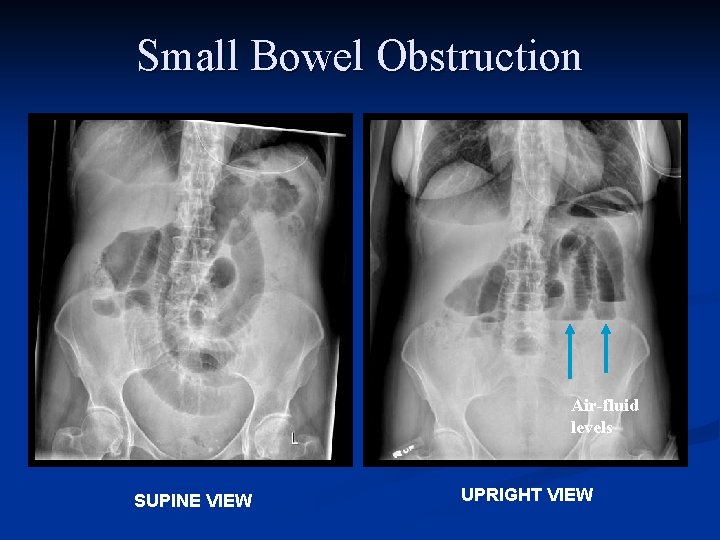 Small Bowel Obstruction Air-fluid levels SUPINE VIEW UPRIGHT VIEW 