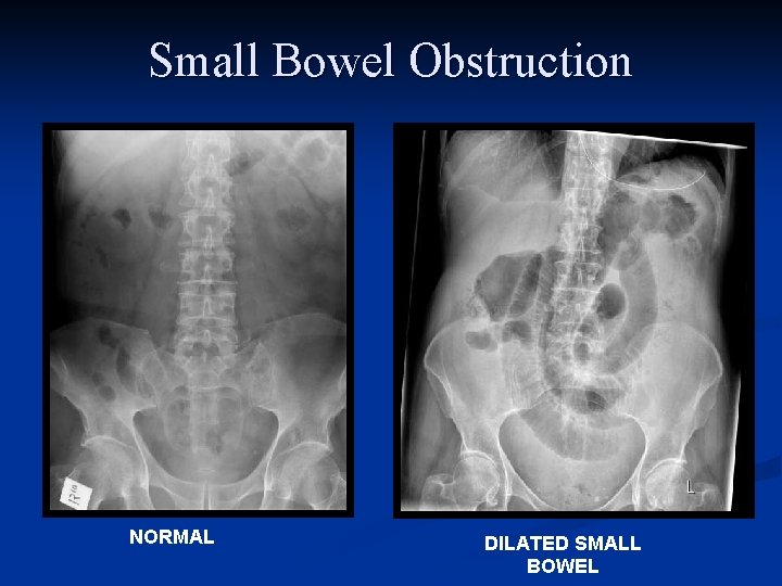Small Bowel Obstruction NORMAL DILATED SMALL BOWEL 