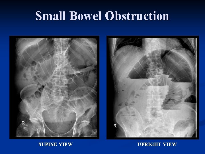Small Bowel Obstruction SUPINE VIEW UPRIGHT VIEW 