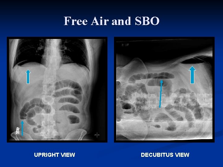 Free Air and SBO UPRIGHT VIEW DECUBITUS VIEW 