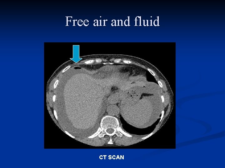 Free air and fluid CT SCAN 