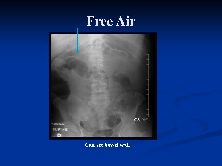 Free Air Can see bowel wall 